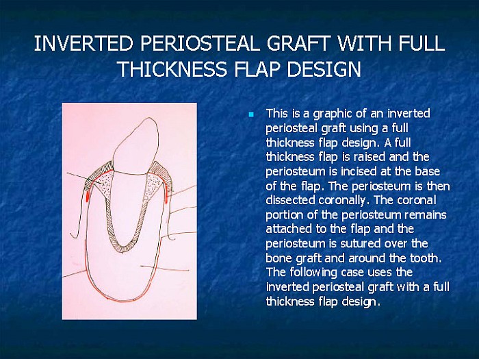 Inverted Periosteal Graft for Periodontal Disease Steiner Biotechnology™