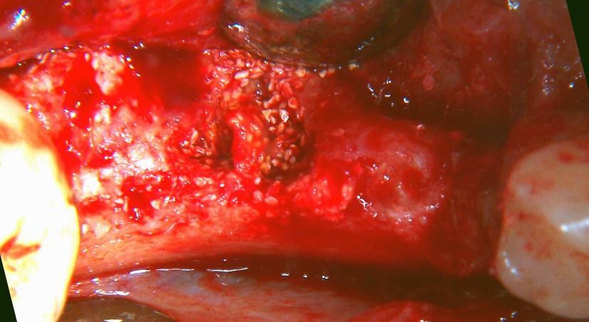 site grafted with freeze-dried bone allograft showing loose cadaver bone graft particles in granulation tissue