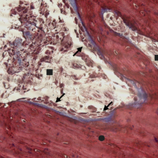 Use of BTCP in Sinus Lifting