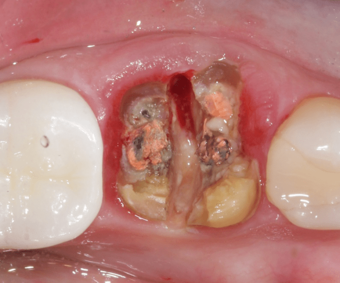 sulcular incisions are made to separate periodontal ligament from tooth