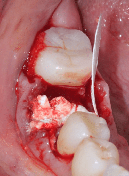 socket is slightly overfilled with Socket Graft Injectable