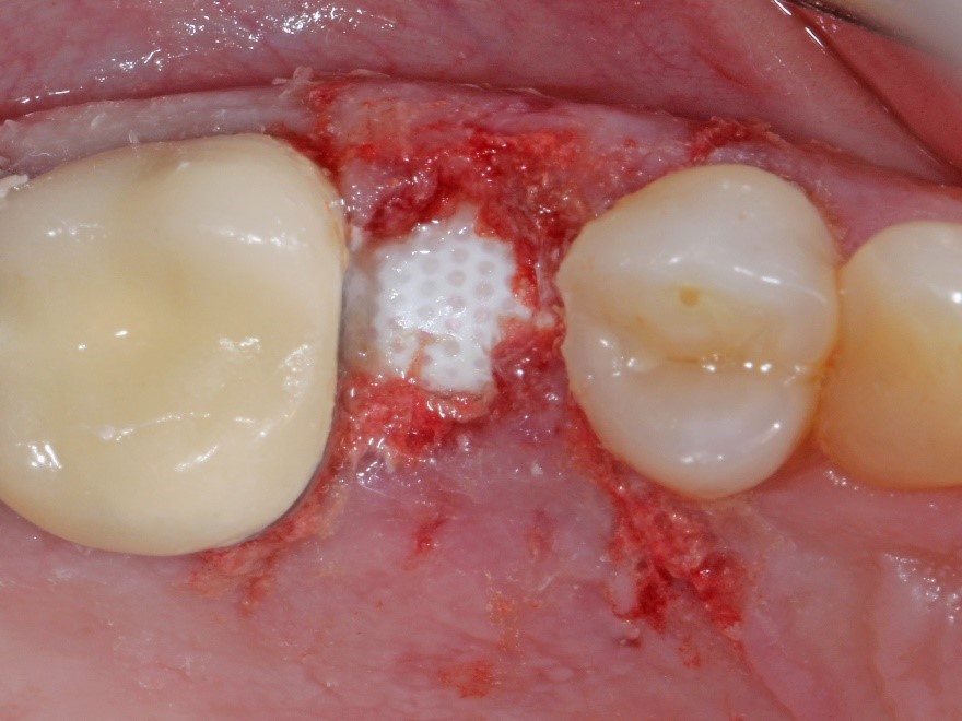 Sutureless socket membrane