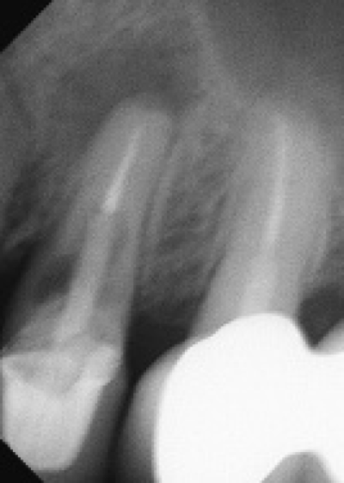 root resorption and a significant endodontic lesion