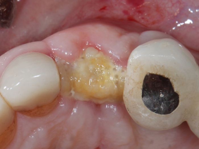 membrane secured with Oral Bond and no sutures