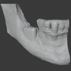 3D rendering of patient's mandible needing vertical and horizontal ridge augmentation and graft design