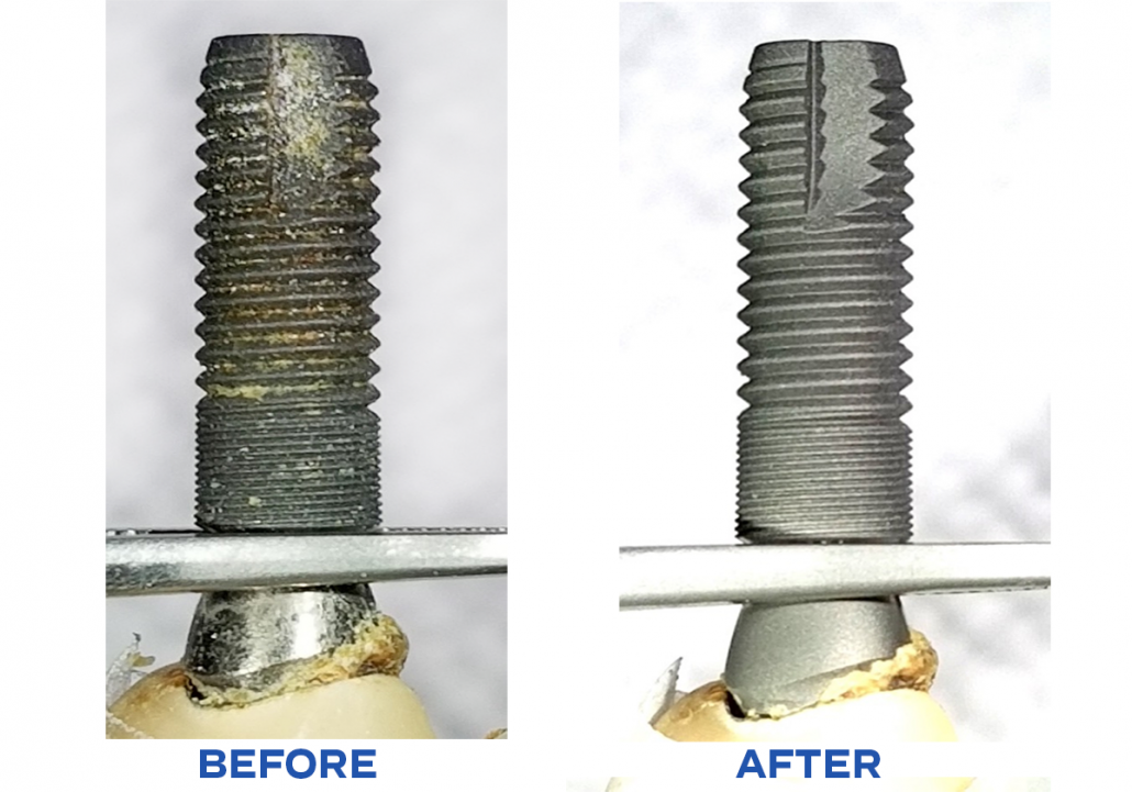 failed implant with retained cement cleaned with βTCP air abrasion