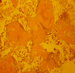 Mineralized freeze-dried bone allograft histology