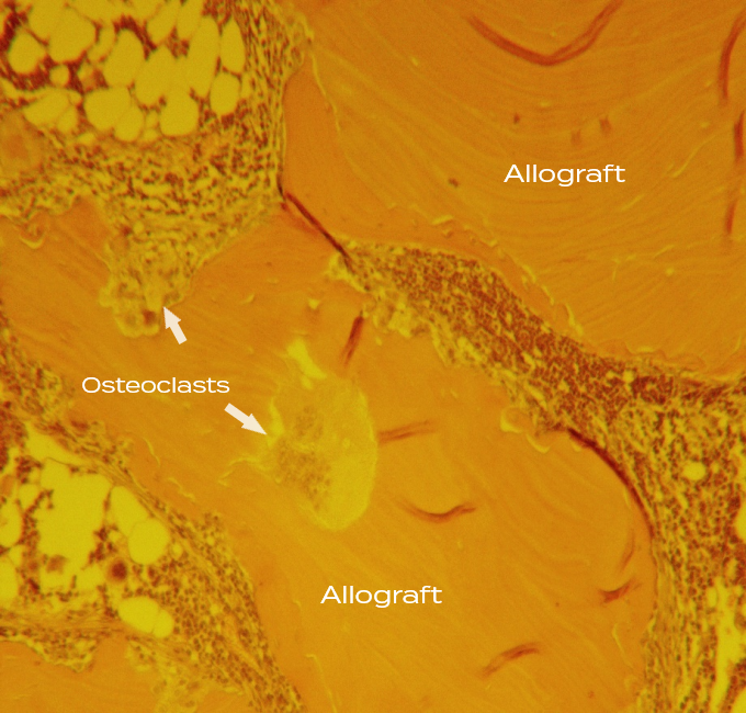 Mineralized freeze-dried bone allograft histology with large osteoclast on the surface of an allograft particle