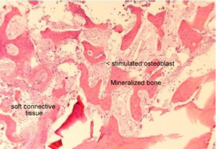βTCP synthetic dental bone graft histology showing mineralization and robust osteoblasts producing woven bone