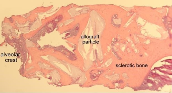 mineralized freeze-dried bone allograft histology in human with sclerotic bone