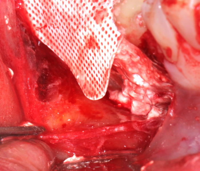 ridge augmentation surgery and buccal flap periosteum is grasped