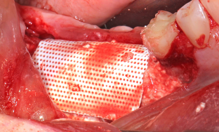 ridge augmentation surgery with teflon membrane folded over synthetic dental bone graft material
