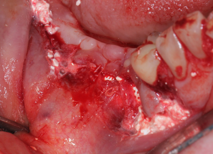 ridge augmentation with sutured periosteum