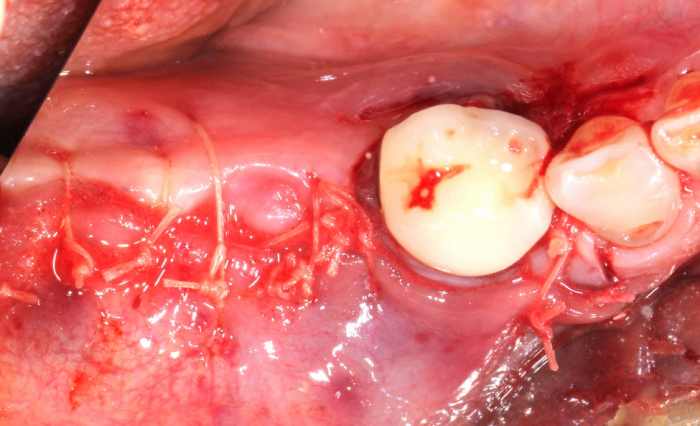 ridge augmentation surgery showing mucosa closed with 40 Vicryl suture