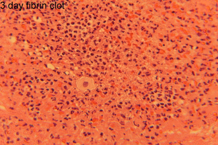 fibrin clot in human bone showing red blood cells and acute inflammatory cells