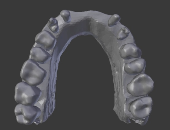 occlusal view of PRF failure