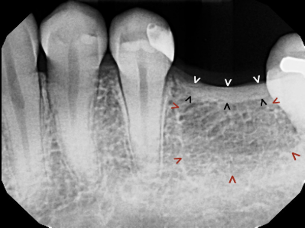 radiograph of extracted molar site showing thick alveolar crest and poorly mineralized cancellous bone below the crest