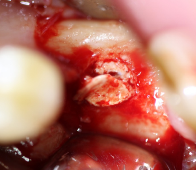 implant surgery showing osteotomy filled with synthetic dental bone graft