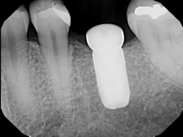 3-month post-op radiograph of implant surgery and socket grafting with synthetic dental bone graft showing normal healthy crestal bone