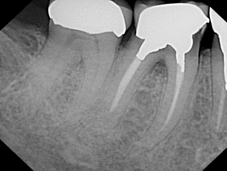 pre-op radiograph showing first molar before extraction and socket grafting