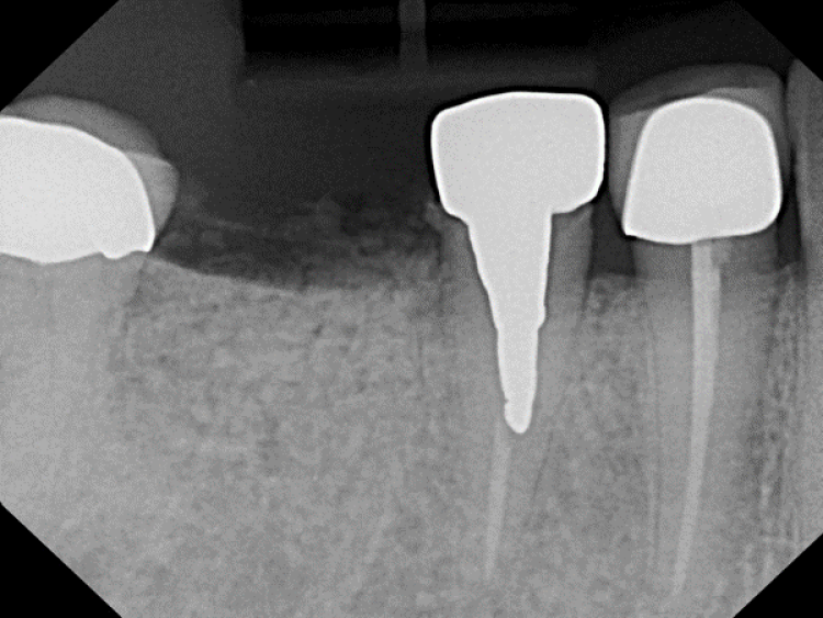 radiograph of socket grafting site grafted with synthetic dental bone graft
