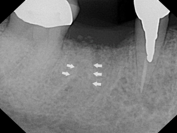 post-op radiograph of socket grafting site after 4 months