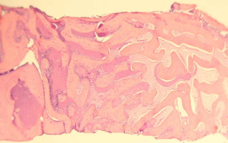 human interradicular bone histology showing healthy vital bone with early trabeculae formation