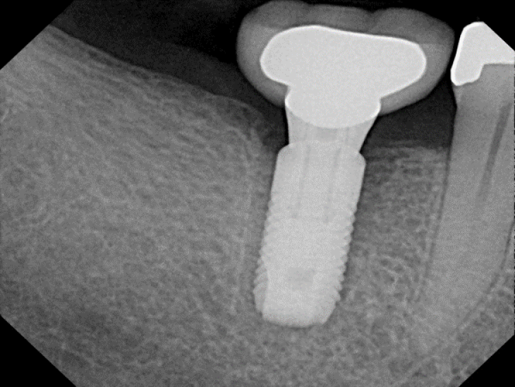 radiograph showing spinner implant separated from bone