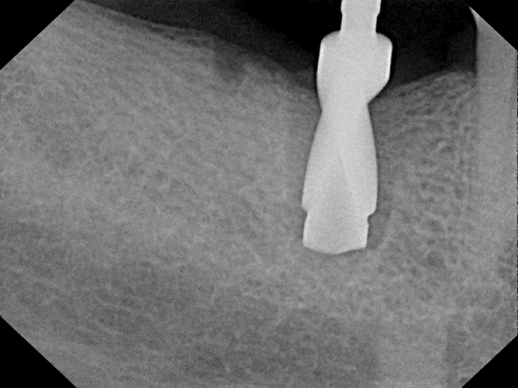 radiograph of socket grafting surgery with drill in the implant site