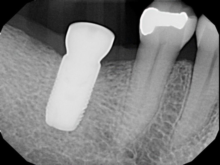post-op radiograph of grafted socket showing high bone density