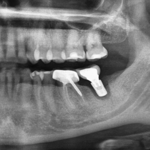 radiograph of bone graft breakdown