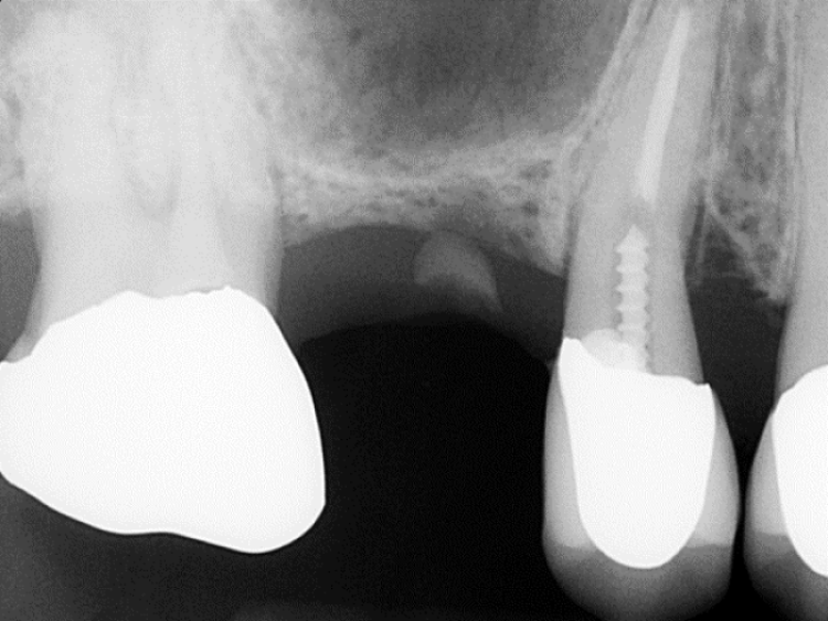 radiograph showing minimal crestal bone with retained root tip and failing bicuspid
