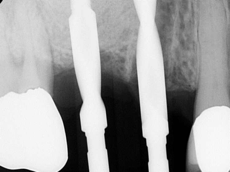 radiograph of sinus augmentation surgery with osteotomy preparation
