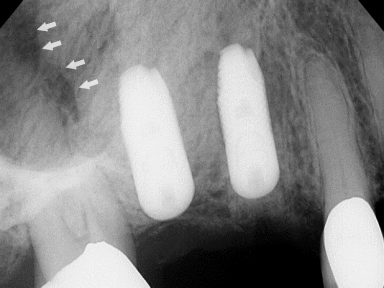 radiograph of sinus augmentation surgery with implant placement