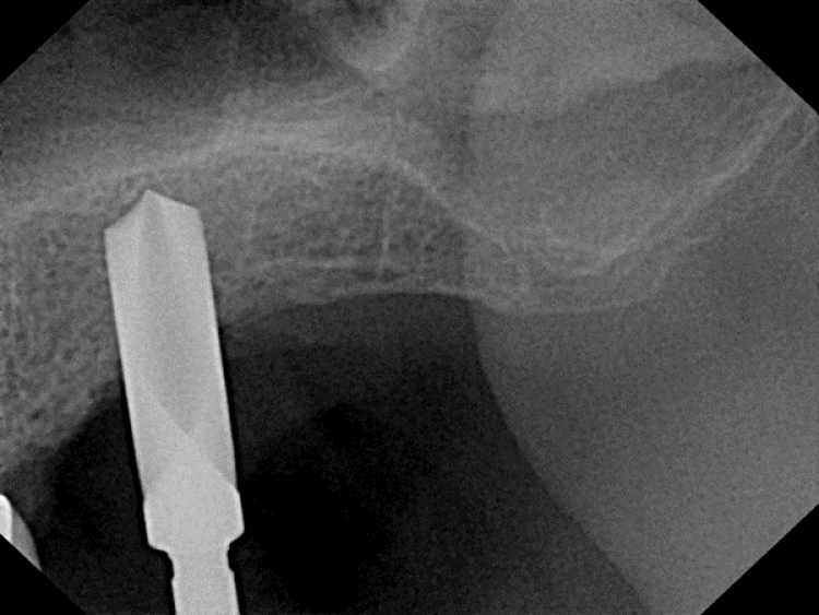 radiograph of sinus augmentation surgery with drill exposing sinus