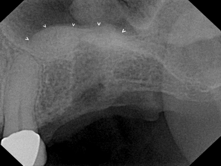 radiograph after sinus augmentation surgery with synthetic dental bone graft material under the sinus membrane