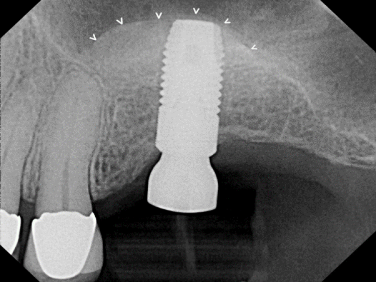 radiograph after sinus augmentation surgery and implant placement with mineralization moving into preexisting bone