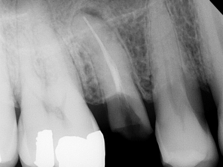 radiograph of unrestorable bicuspid showing a periapical lesion with a buccal fistula