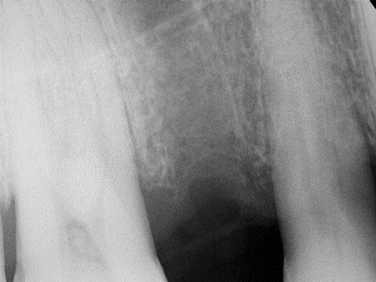 radiograph of socket 2 weeks after grafting showing radiopaque synthetic dental bone graft material