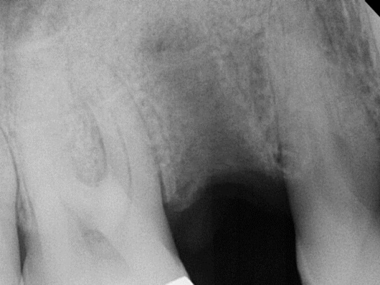 radiograph of socket filled with mineralized tissue 7 weeks after socket grafting
