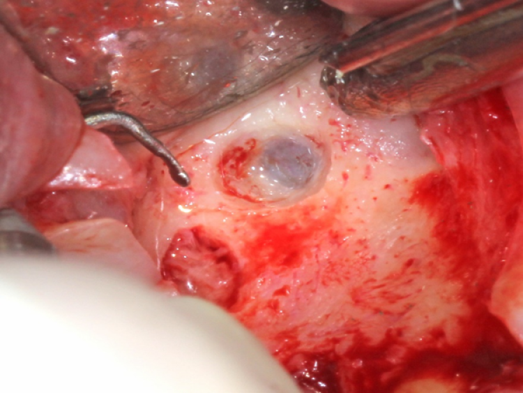 sinus membrane visible during sinus augmentation surgery