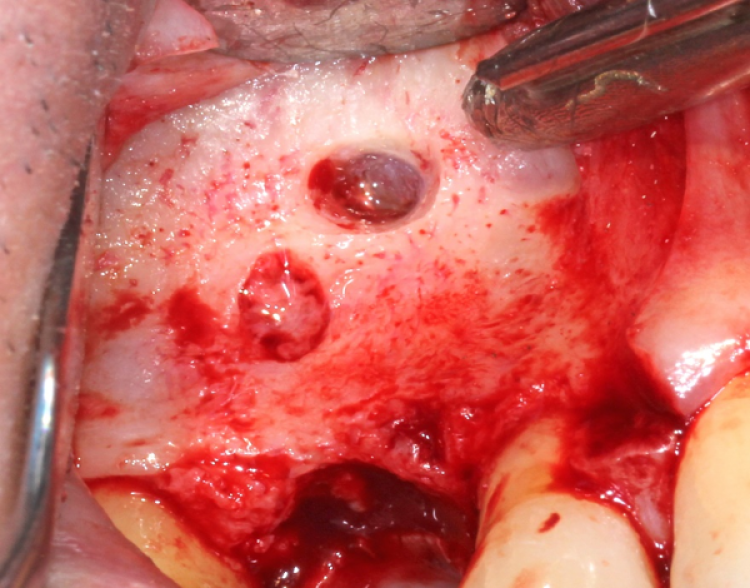 dissected sinus membrane during sinus augmentation surgery