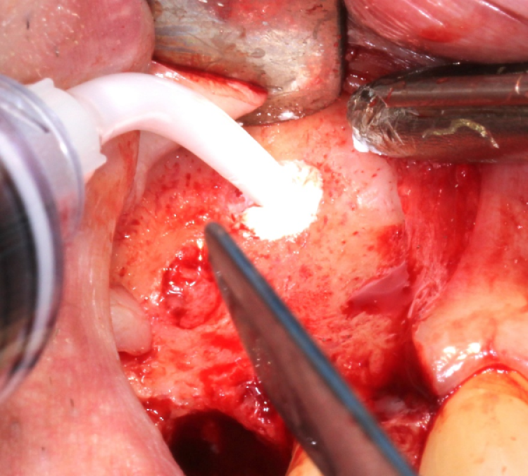 synthetic dental bone graft injected into osteotomy during sinus augmentation surgery