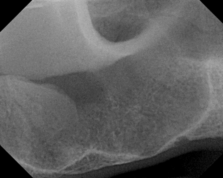 radiograph of sinus with minimal crestal bone and a mucus retention cyst