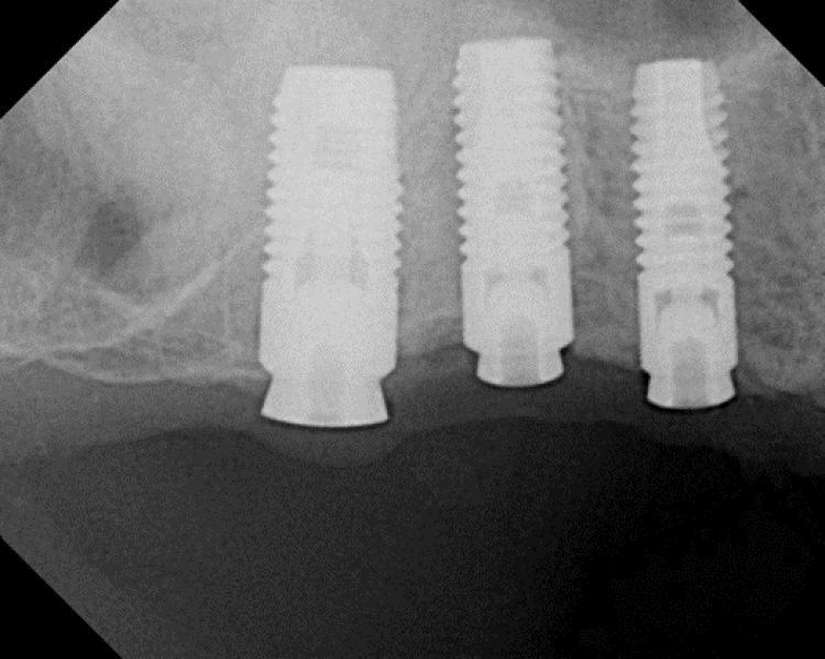 radiograph of implants after sinus augmentation surgery