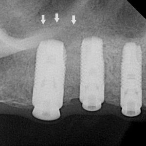 post op radiograph after sinus augmentation surgery showing implant integration and regenerated sinus membrane