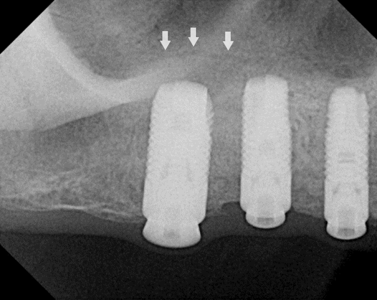 post op radiograph after sinus augmentation surgery showing implant integration and regenerated sinus membrane