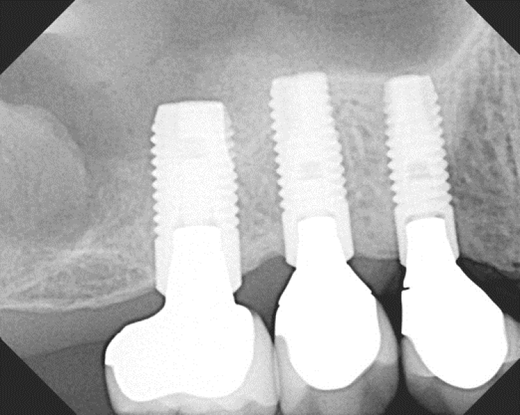 radiograph of dental implants one year after restoration