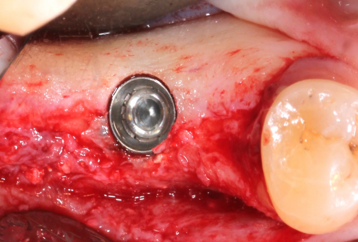 ridge augmentation surgery showing missing bone on the buccal of a knife edge ridge