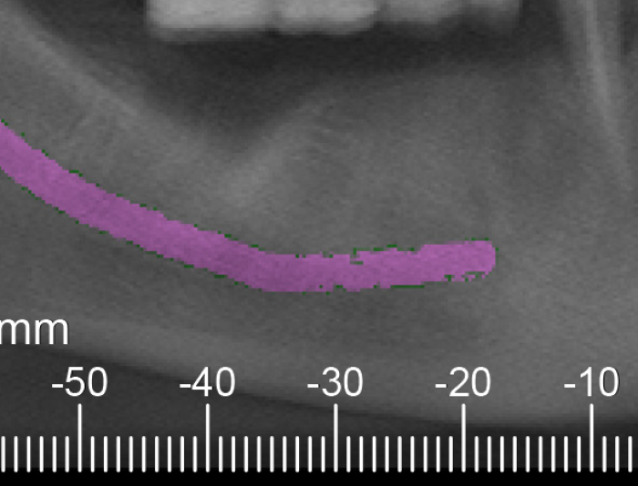 mandibular pre-op CT scan with inadequate width in bicuspid area and inadequate height in molar area